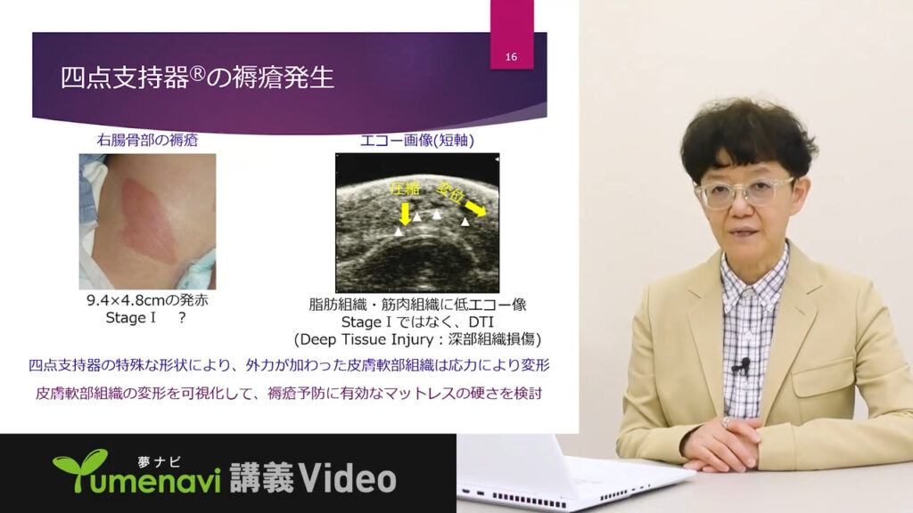 夢ナビ講義動画「手術室の褥瘡(じょくそう)予防」